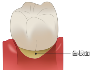 露出した歯根面