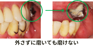 入れ歯とプラーク