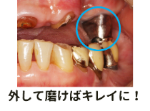 入れ歯とプラーク