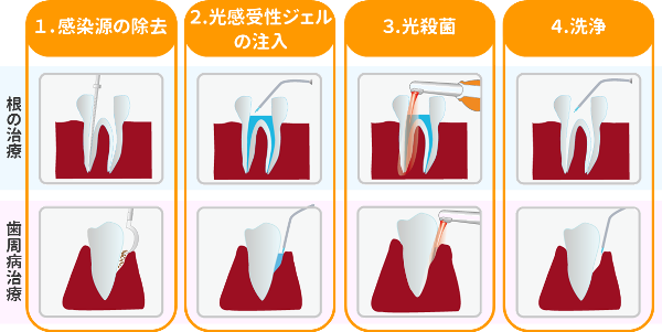 光殺菌治療の手順