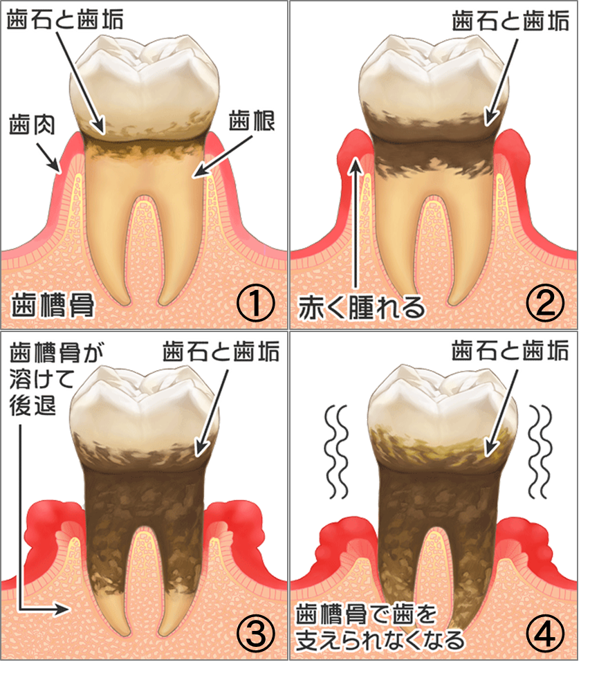 歯周病