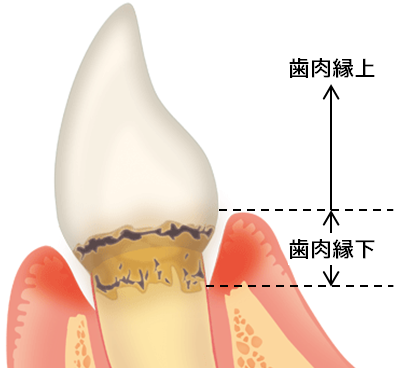 歯肉縁上と縁下